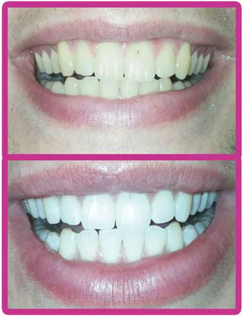 28936 teeth whitening spain clinic2