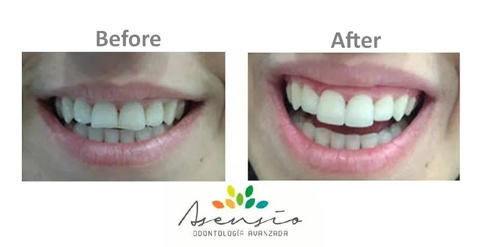 28936 teeth whitening spain clinic4