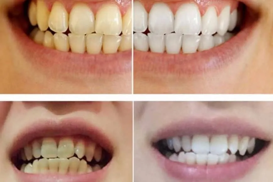 /img/28936-teeth-whitening-spain-smile.webp