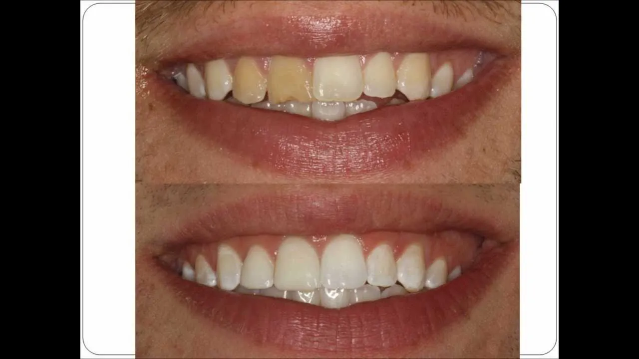28936 teeth whitening spain technology