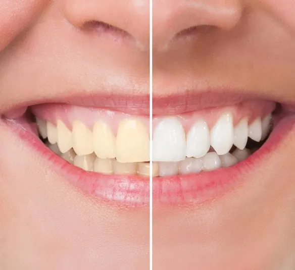 28943 at home teeth whitening