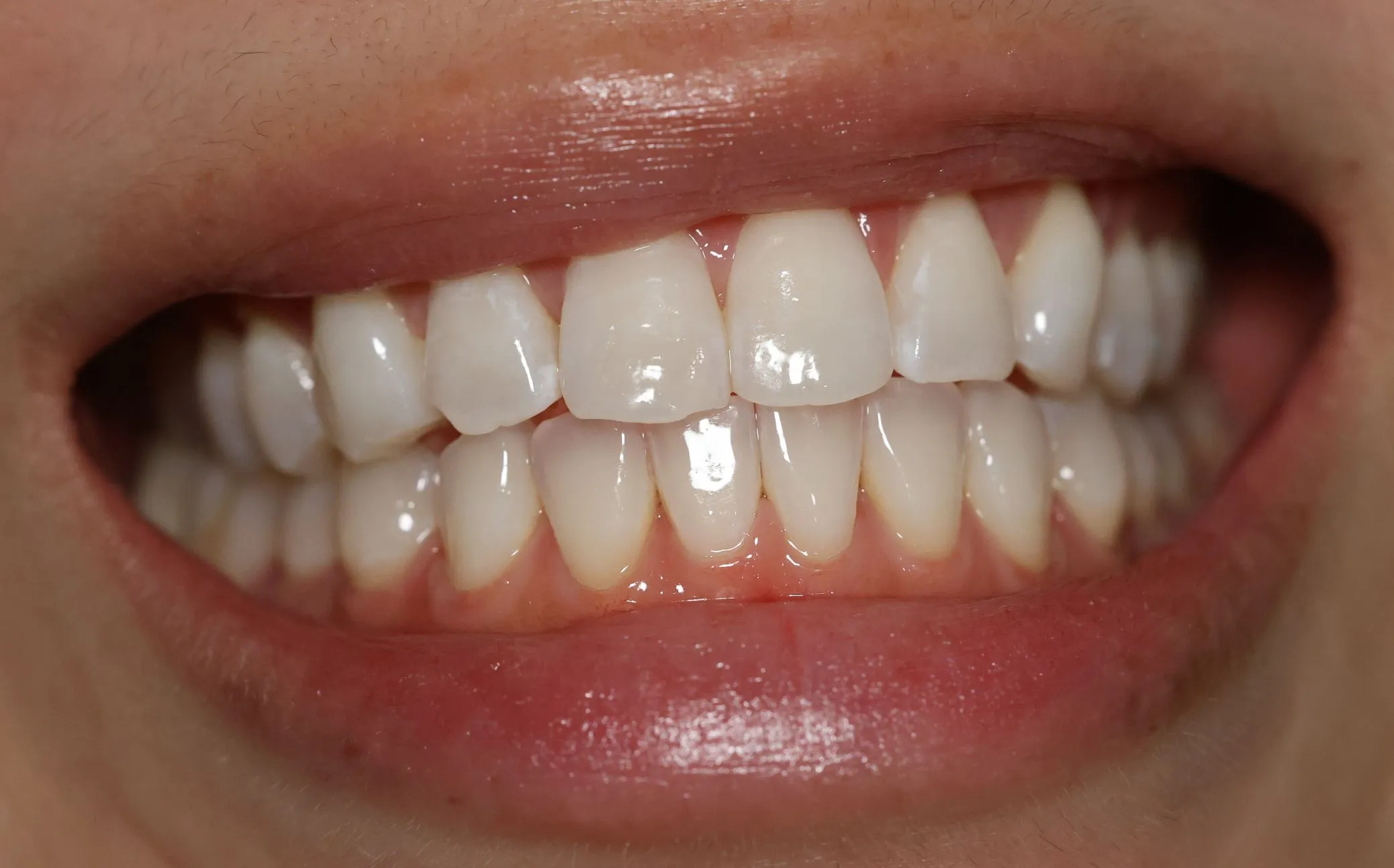 28943 professional teeth whitening