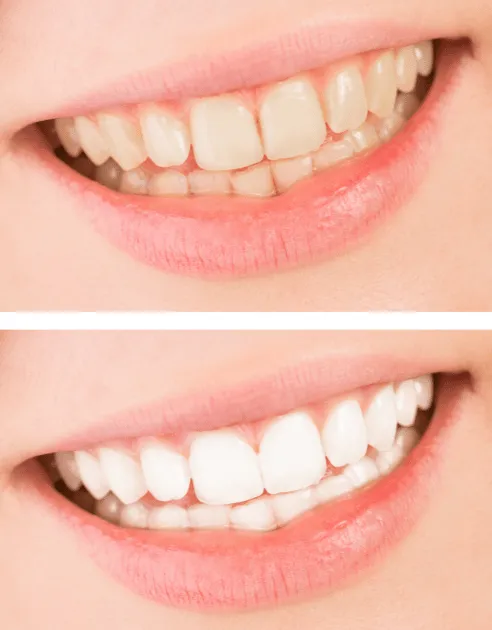 /img/28943-teeth-whitening-aftercare.webp