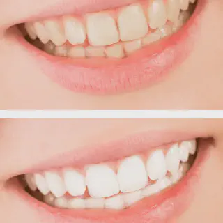 /img/28943-teeth-whitening-aftercare.webp