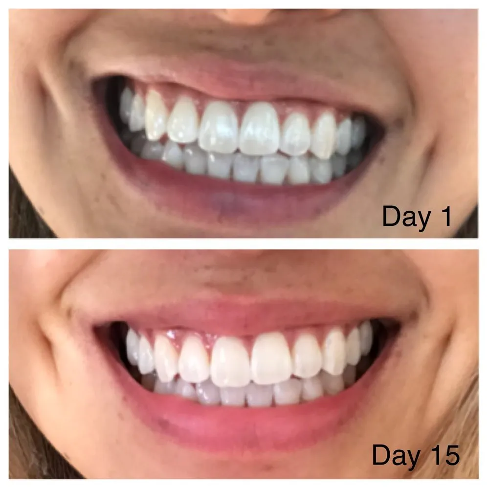 28944 oil pulling teeth whitening image6