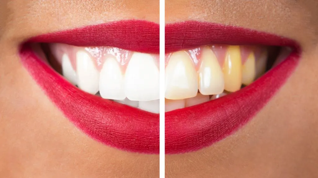 28945 in office teeth whitening