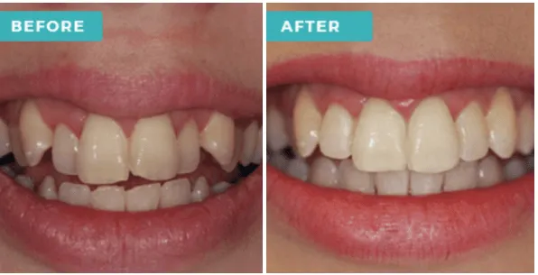 28945 laser teeth whitening