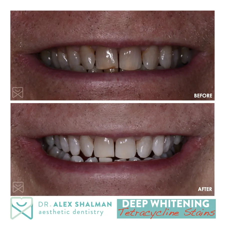 28946 kor teeth whitening near me 1