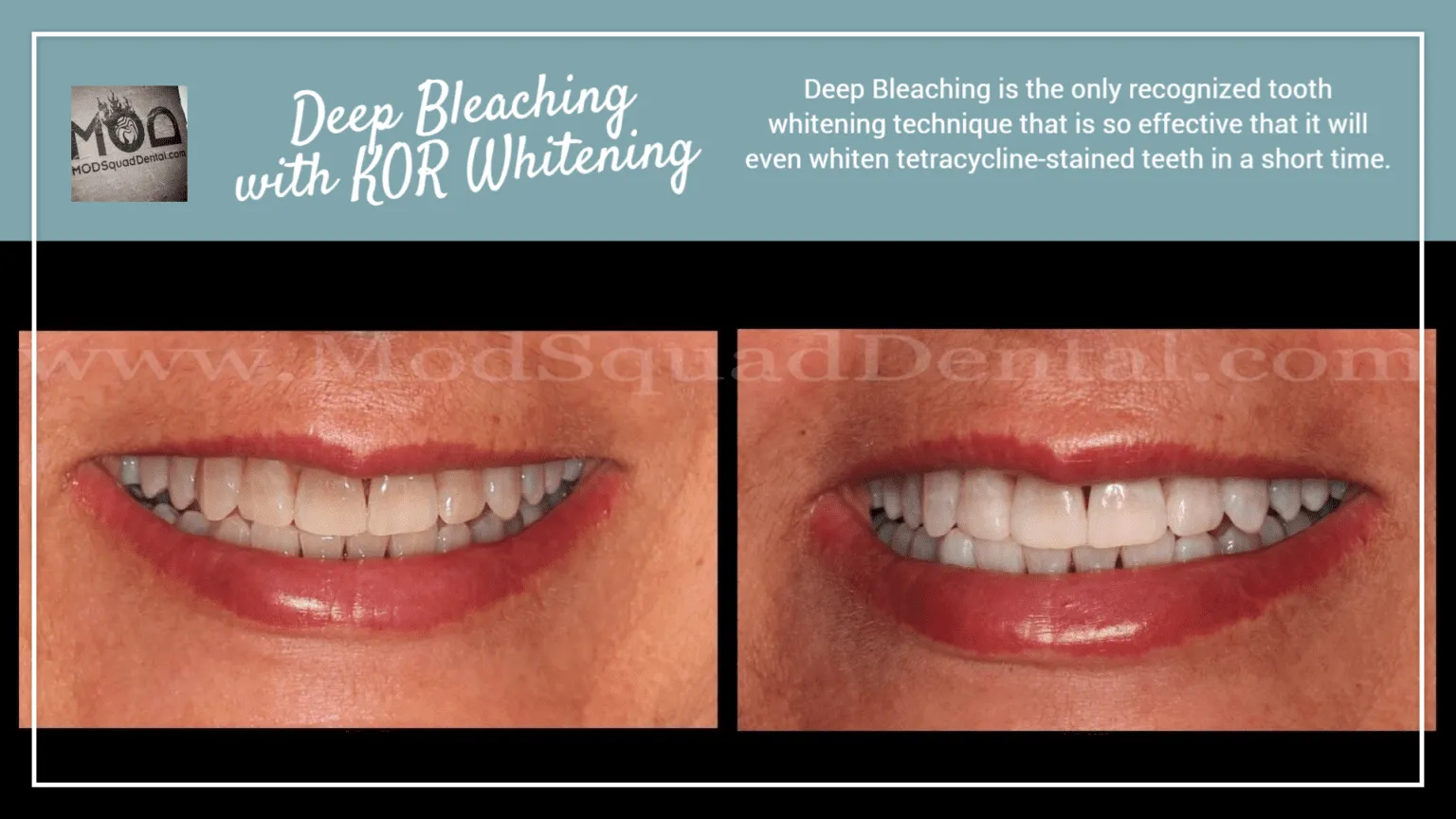 28946 kor teeth whitening results