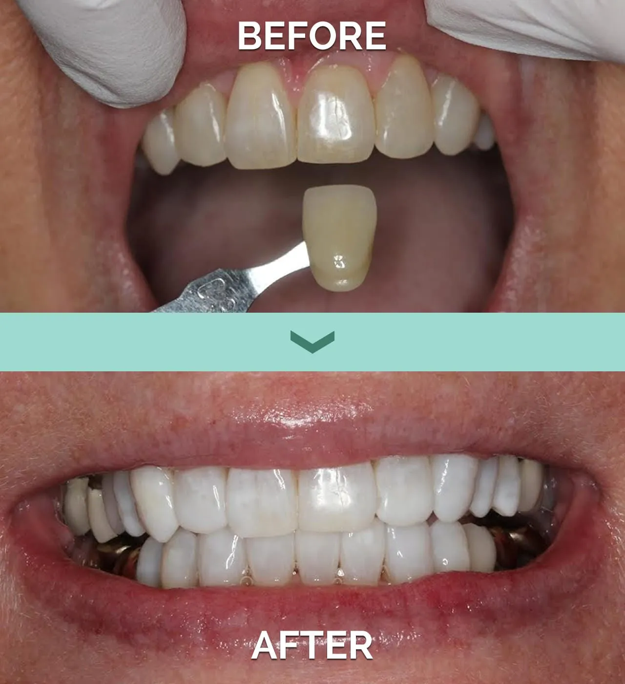 28946 teeth whitening aftercare
