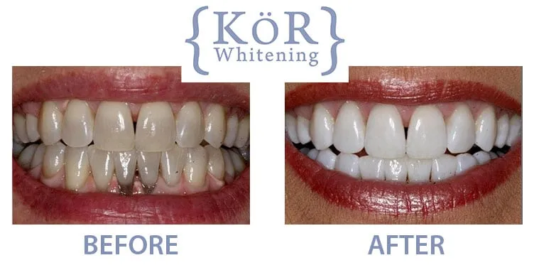 28946 teeth whitening deals