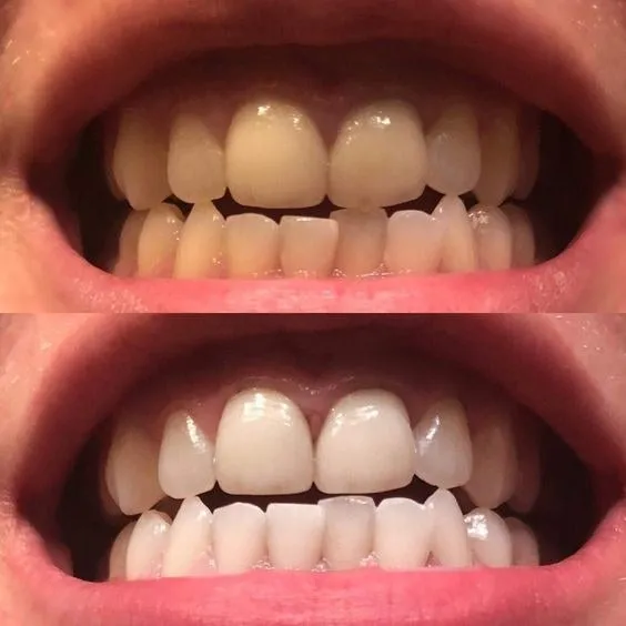 28947 whitening toothpaste