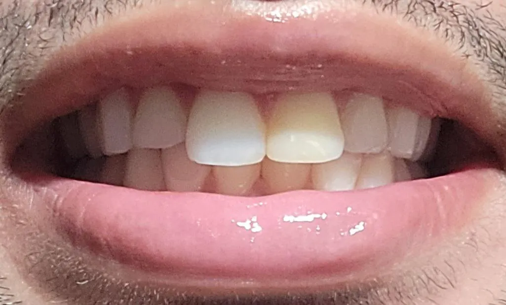 28950 custom tray whitening