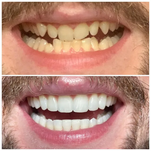 28950 tooth whitening products