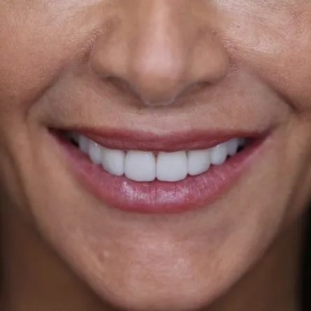 28951 teeth whitening palm coast confidence