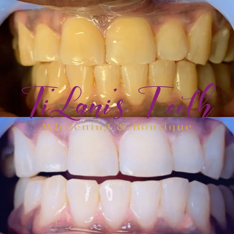 28951 teeth whitening palm coast professional