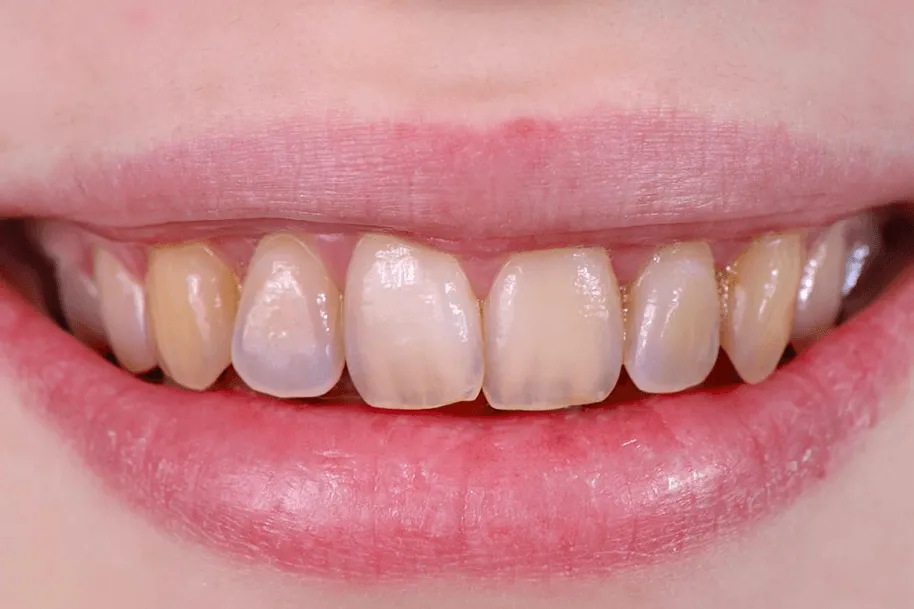 28955 enamel damage teeth