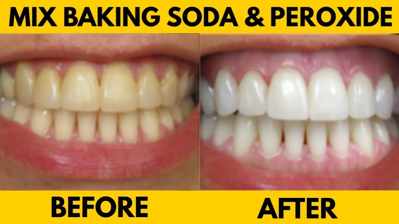 28956 professional teeth whitening