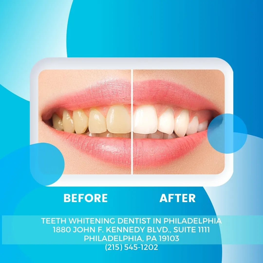 28959 teeth whitening philadelphia smile