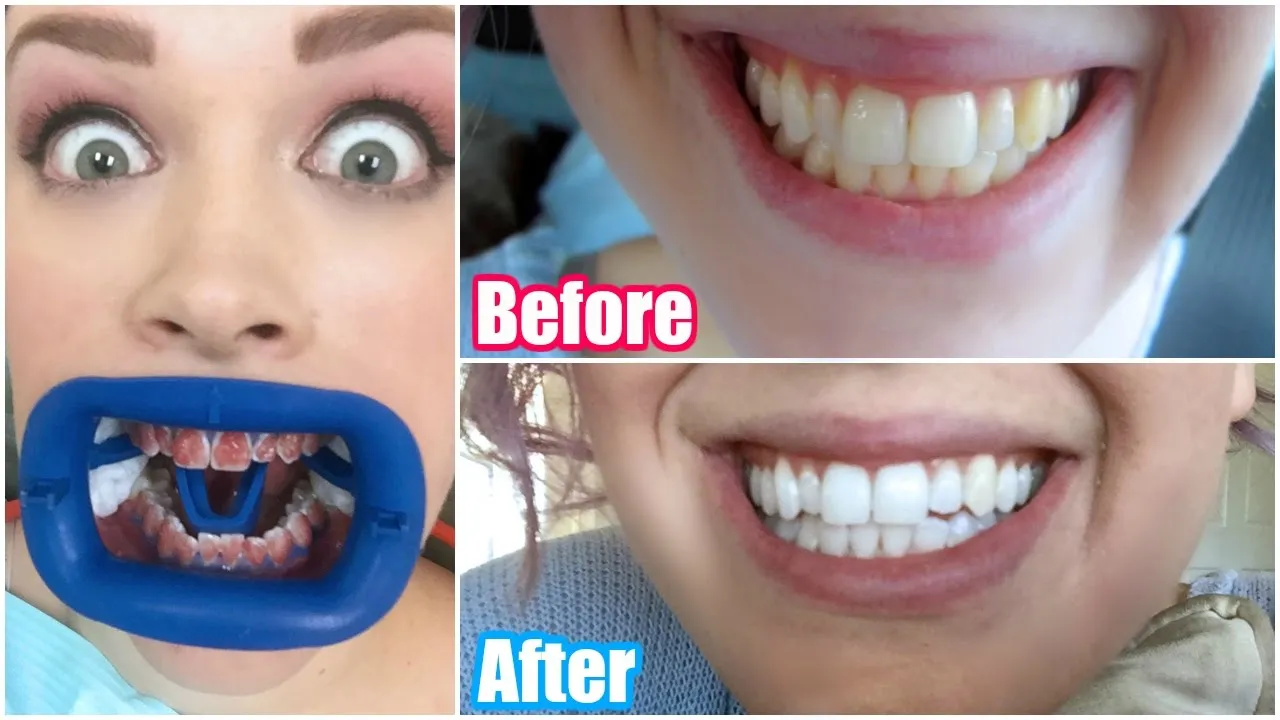 28960 teeth whitening results