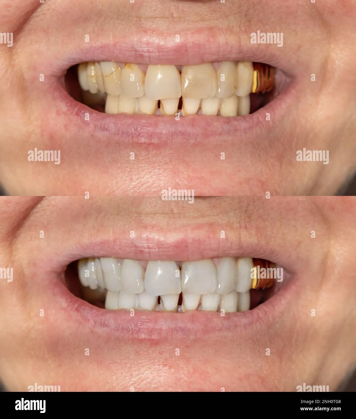 28960 tooth discoloration