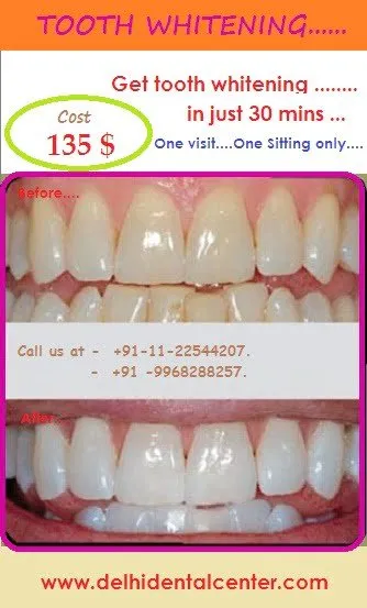 28962 in office teeth whitening