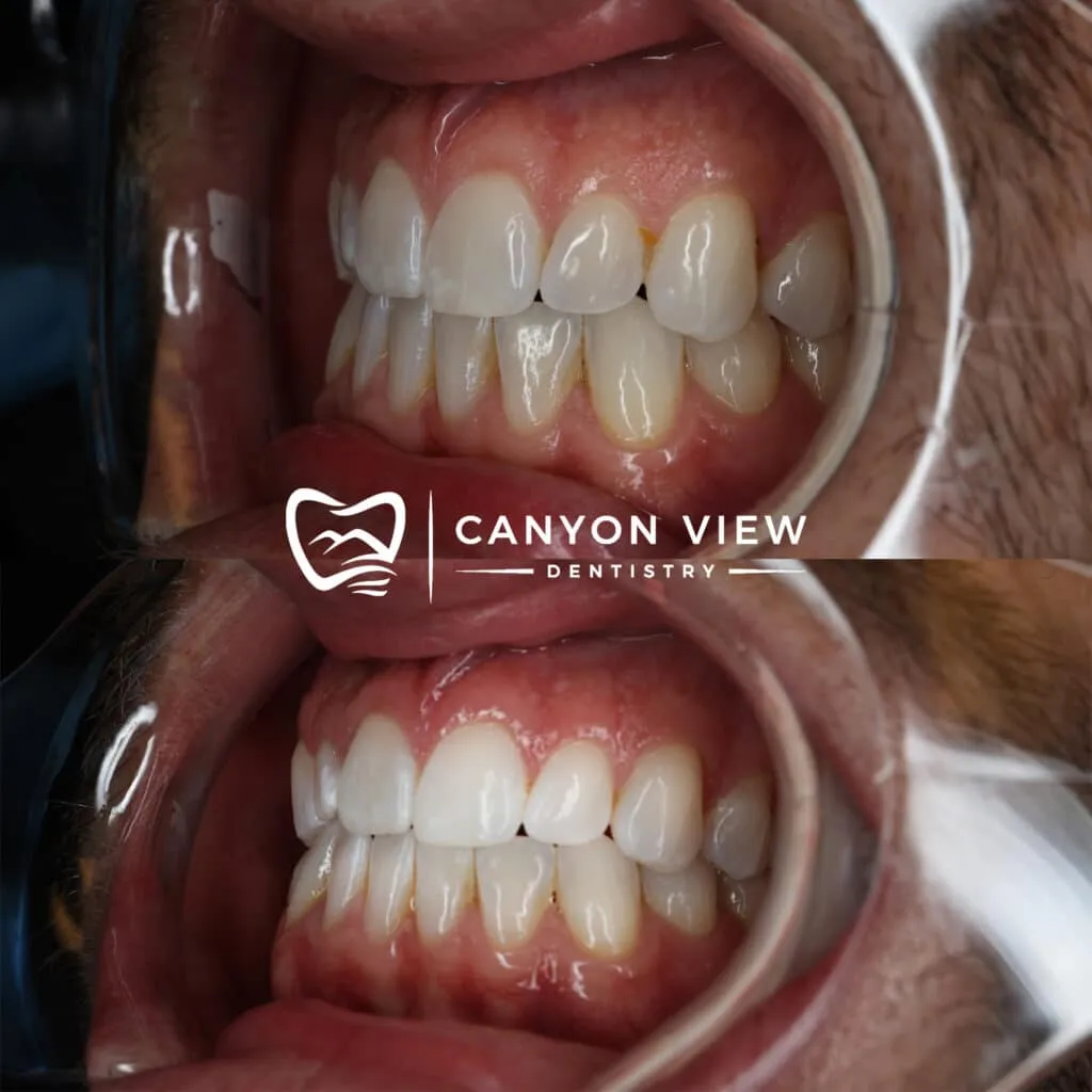 28963 at home teeth whitening