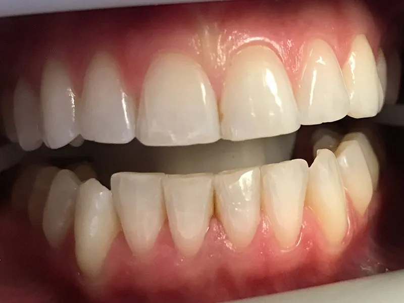 28963 teeth whitening maintenance