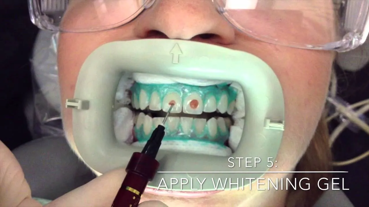 /img/28967-teeth-whitening-aftercare.webp