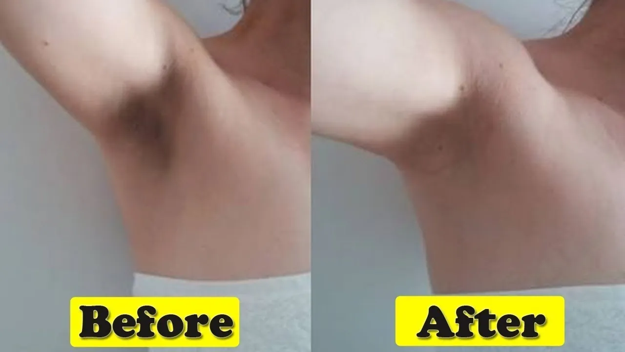 28971 laser underarm whitening