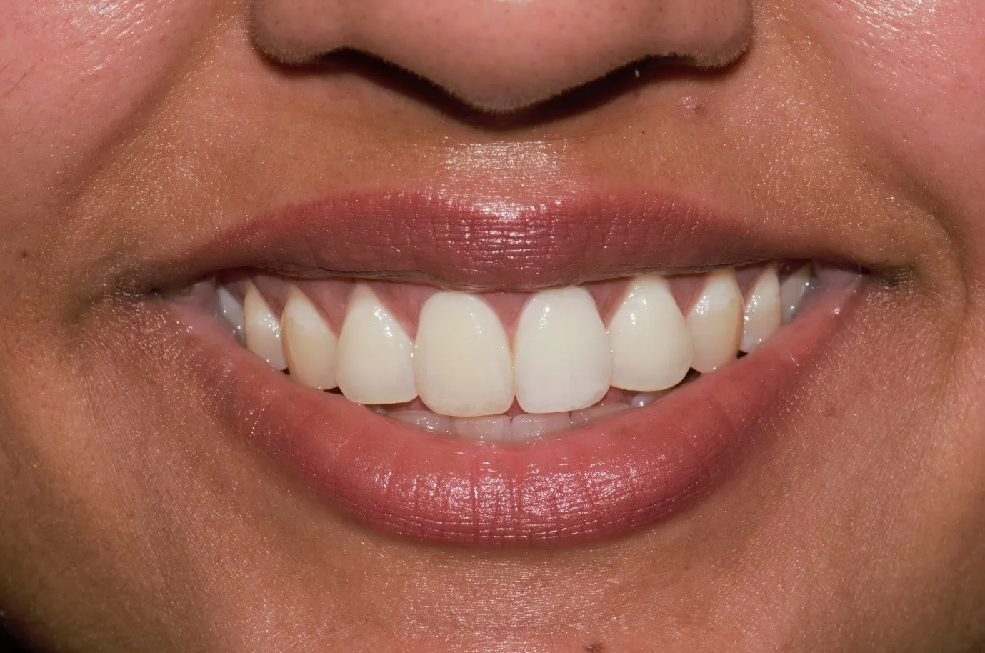 28972 in office teeth whitening