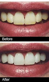28972 teeth whitening before after