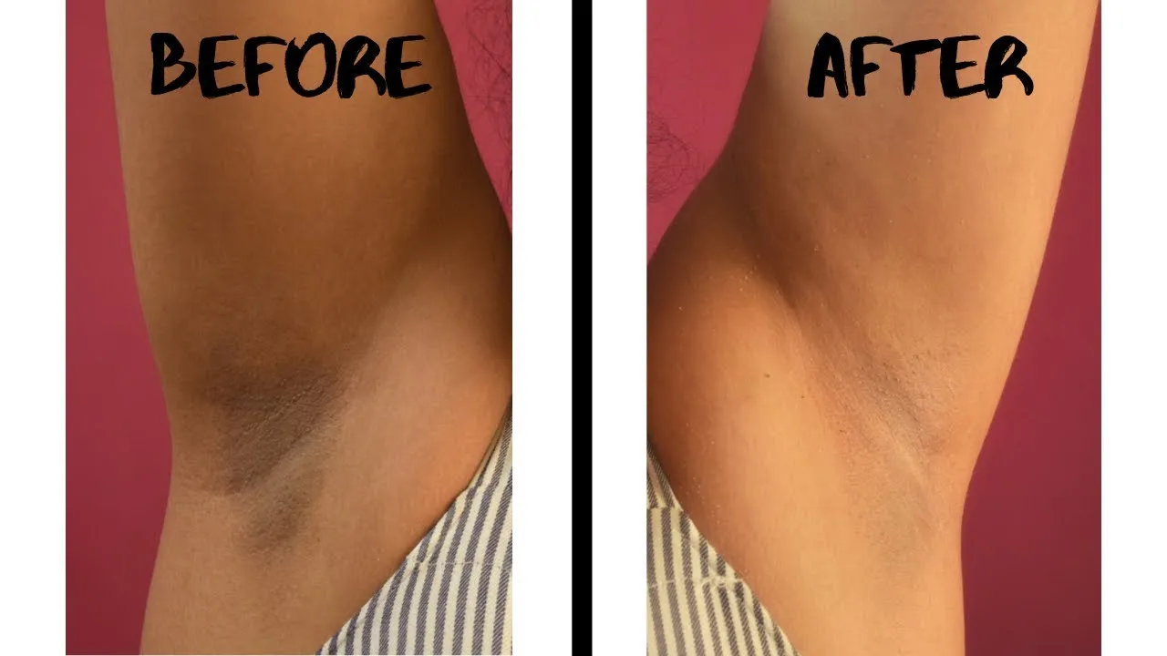 28974 armpit whitening at home image1