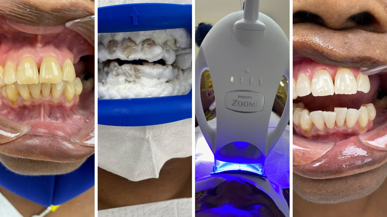 28976 zoom teeth whitening alternatives