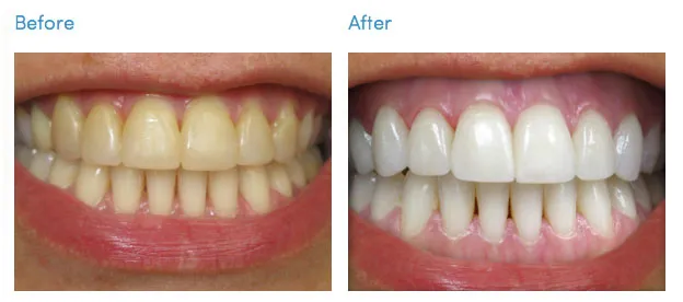 28976 zoom teeth whitening cost factors