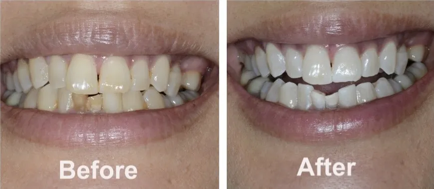 28976 zoom teeth whitening session