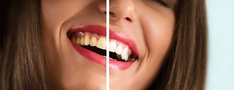 28978 teeth whitening bend or before after