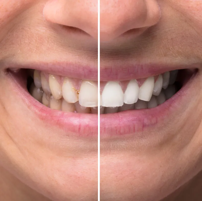 /img/28978-teeth-whitening-bend-or-diet.webp