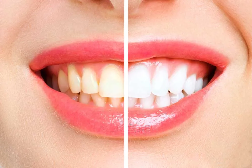 28978 teeth whitening bend or healthy teeth