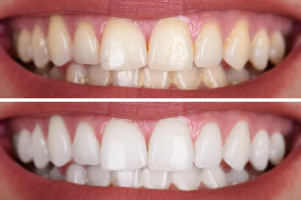 28978 teeth whitening bend or options