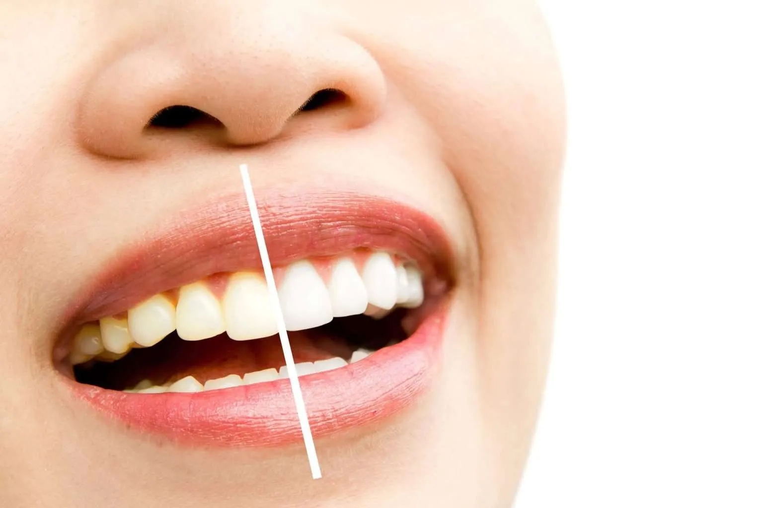 28978 teeth whitening bend or smile