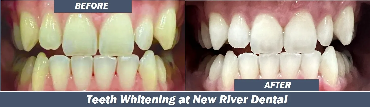 28980 at home teeth whitening products