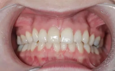 28980 teeth whitening aftercare