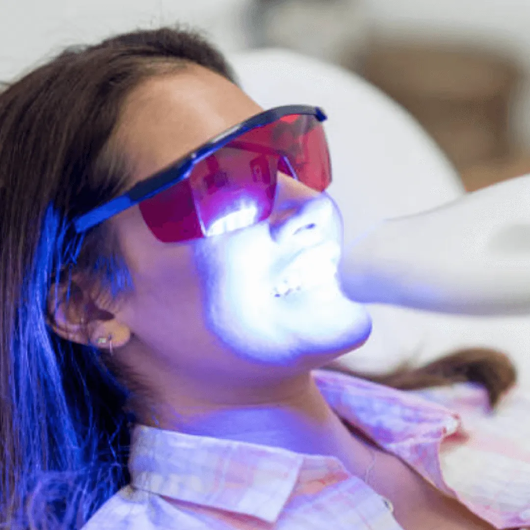 28982 at home whitening kits