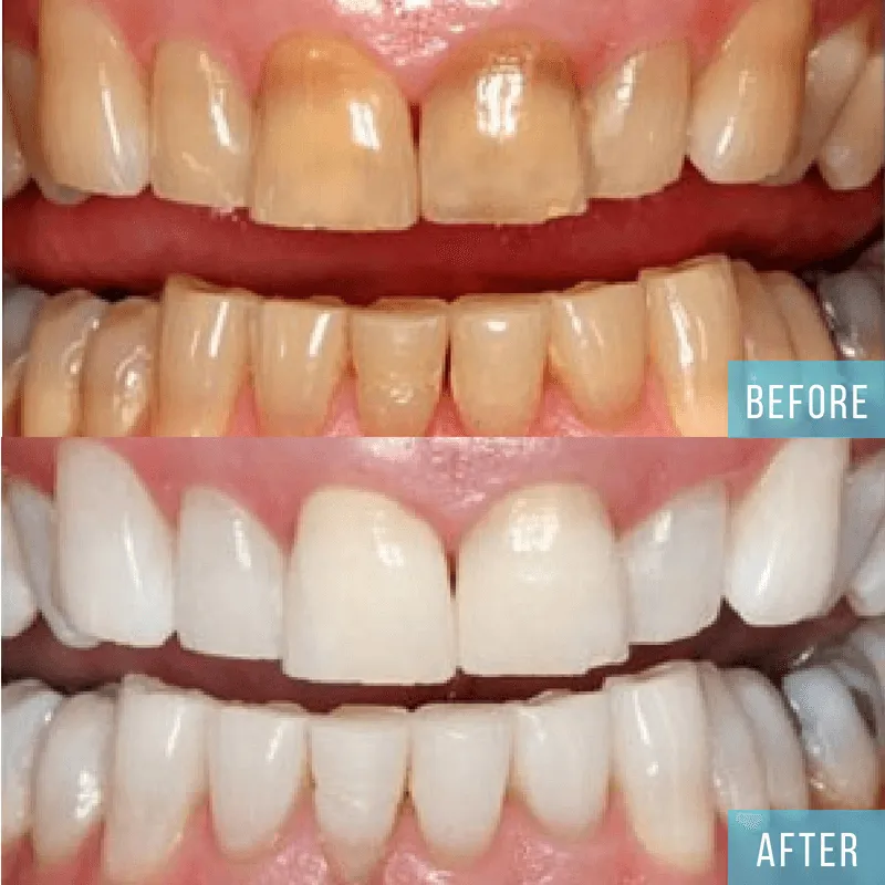 28982 professional teeth whitening