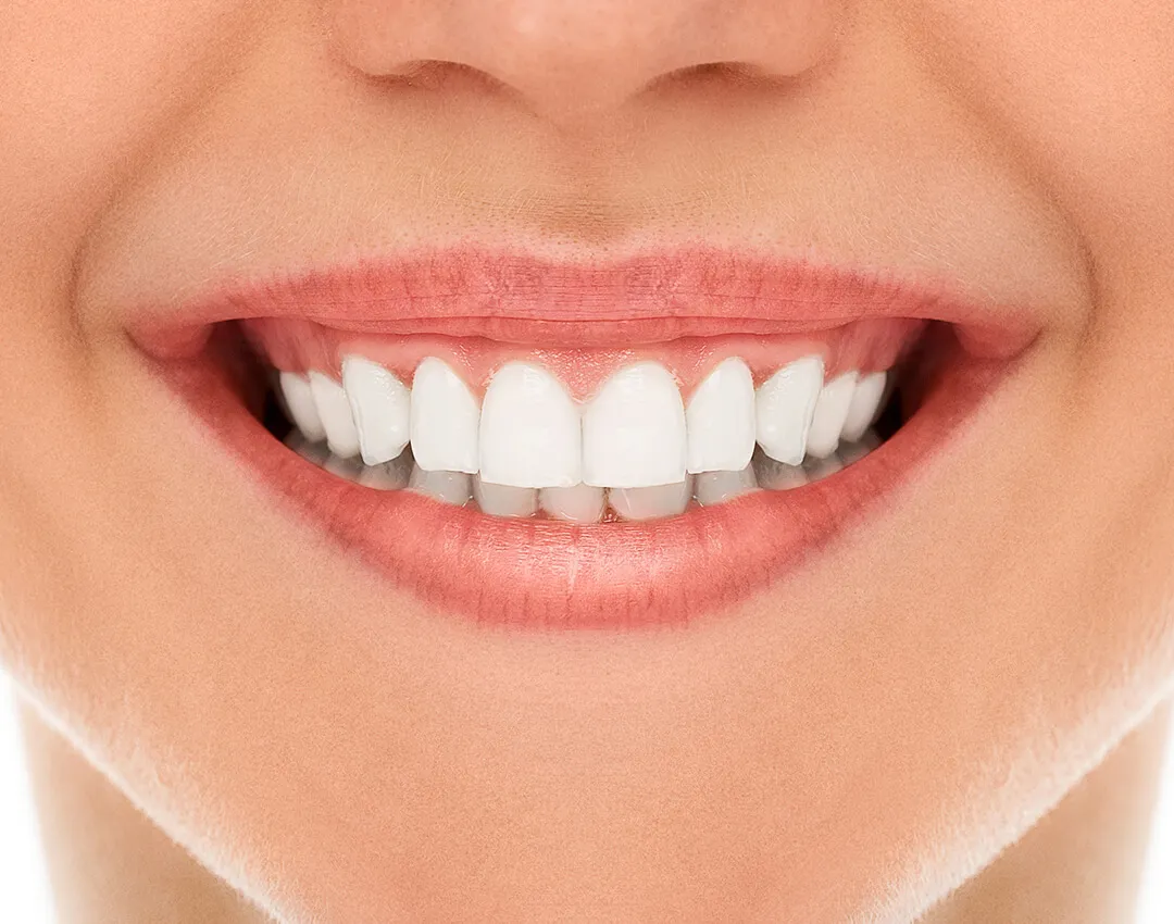28984 professional teeth whitening