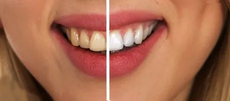 28984 teeth discoloration causes