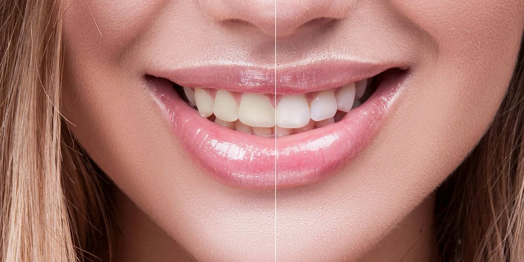 28984 teeth whitening effectiveness