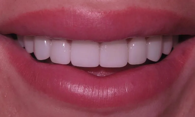 28988 teeth whitening edina results