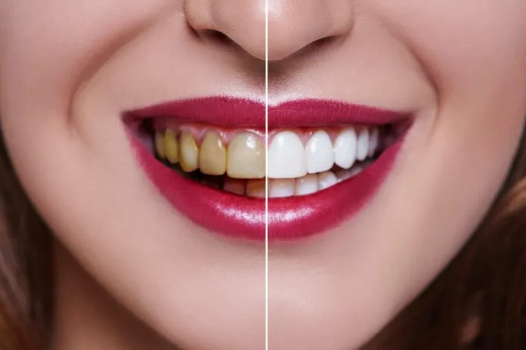 28989 teeth whitening maintenance